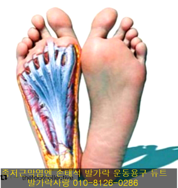 발가락 운동용구 듀트로 족저근막염 완치하세요.